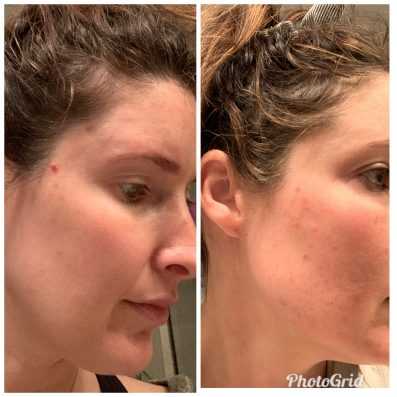 before and after-Premier Med Spa at Richardson, TX