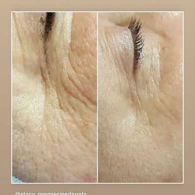before and after microneeding-Premier Med Spa at Richardson, TX