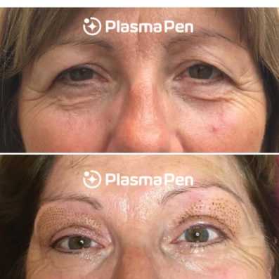 before and after plasma pen -Premier Med Spa at Richardson, TX